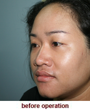 plastic_surgery_augmentation_rhinoplasty